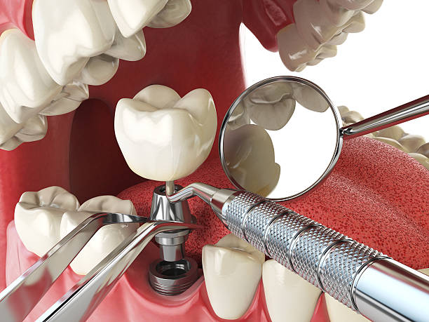 Best Emergency Dental Care for Broken or Chipped Teeth in Searingtown, NY